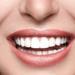 Hollywood Smile Dental Procedure