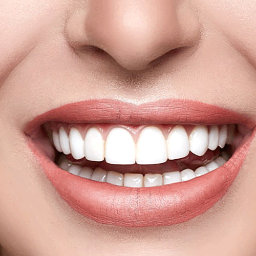 Hollywood Smile Dental Procedure